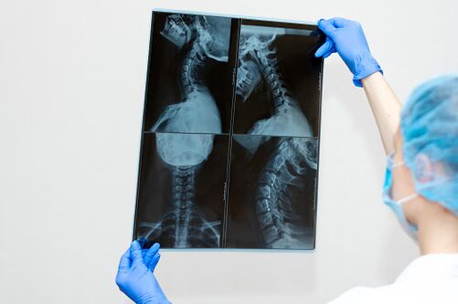 Osteokondrosia bizkarrezurreko gaixotasuna