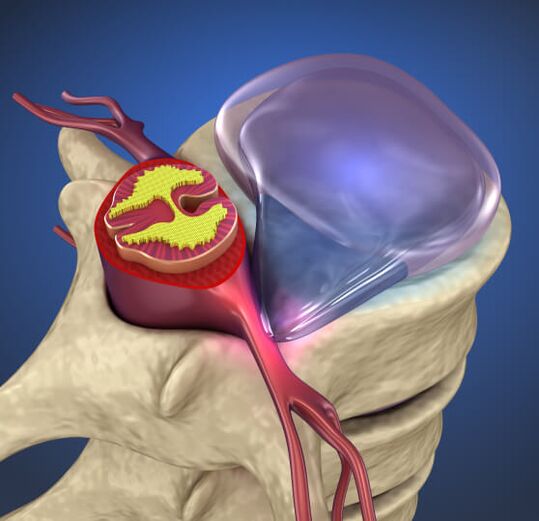 Hernia intervertebral