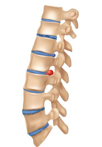 Nolakoa da desofrming osteochondrosia