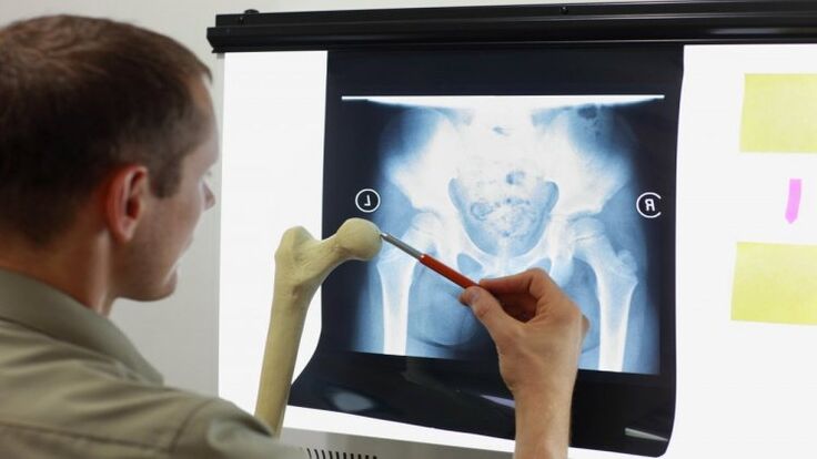 Medikuak erradiografia bat aztertzen du aldakako artrosiaren bila